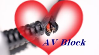 房室ブロック（AV block）
